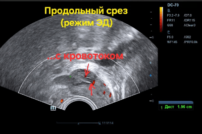 ТРУЗИ режим ЭД